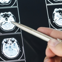 Un nuevo fármaco creado en España demuestra eficacia preclínica contra el tumor cerebral